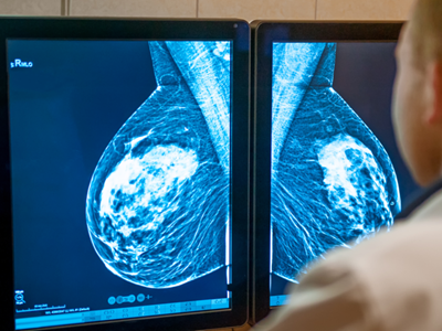 AI4Health.Cro: Traže se AI rješenja za borbu protiv raka dojke