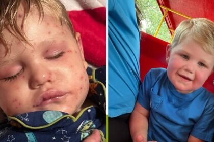 Užas u Americi: Dječaka 150 puta ubole ose, koža mu je požutjela, a organi otkazuju