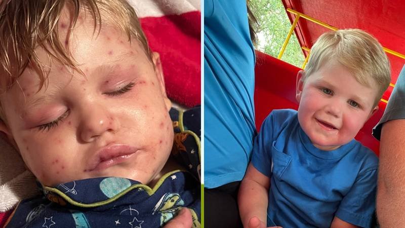 Užas u Americi: Dječaka 150 puta ubole ose, koža mu je požutjela, a organi otkazuju