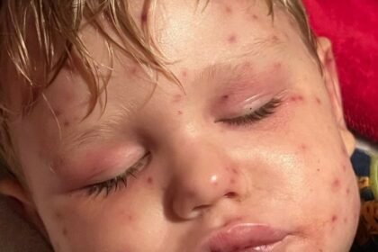 Noćna mora dvogodišnjaka, bori se za život nakon 150 uboda: “Koža mu je požutjela, organi su zatajili…”