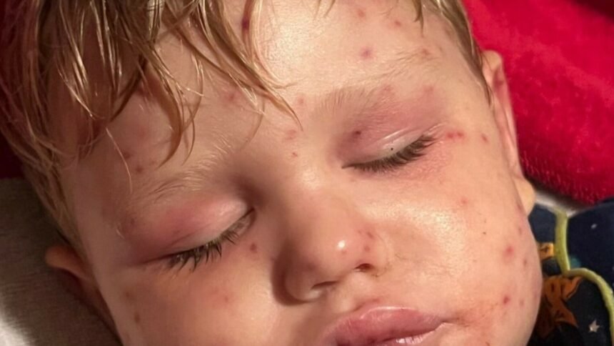 Noćna mora dvogodišnjaka, bori se za život nakon 150 uboda: “Koža mu je požutjela, organi su zatajili…”