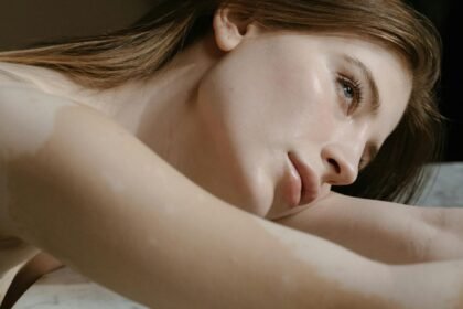 Promene na koži koje ne dovodimo u vezu sa dijabetesom, a upravo ih on izaziva