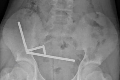 Dječak na Novom Zelandu progutao čak 100 snažnih magneta, formirali četiri lanca u crijevima